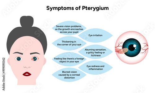 Symptoms of pterygium and pinguecula Optometry disease 