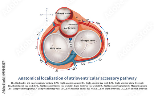 Surrounding the atrioventricular ring, except for the anterior septum of the left ventricle, there is no distribution of accessory pathways, and accessory pathways can exist in other parts. photo