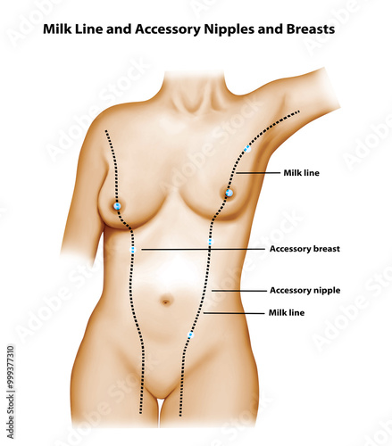 Milk Line and Accessory Nipples and Breasts 