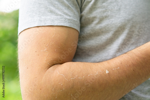 dry sunburn peeling skin on a man's arm 