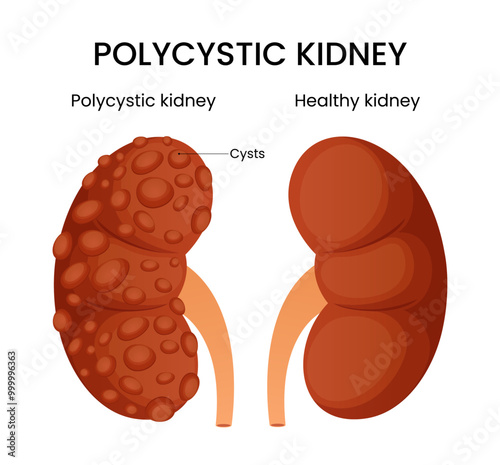 Causes of the Polycystic Kidney