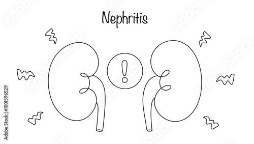 Nephritis