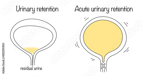 Urinary retention