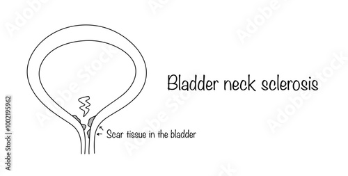 Bladder neck sclerosis