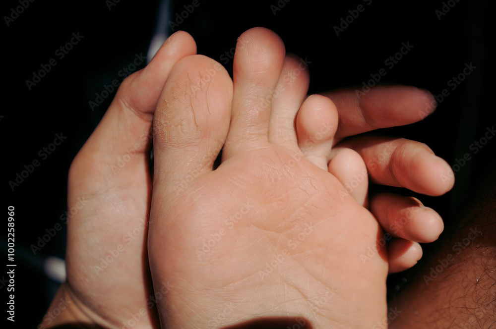 Dry and cracked heels foot. Unhealthy skin from weather which need moisturizer Dry and cracked heels foot. Unhealthy skin from weather which need moisturizer