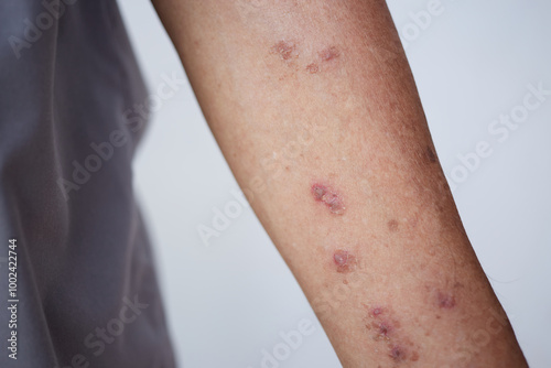 Dermatitis on skin, Skin decease becomes red, swollen, and sore, sometimes with small blisters photo