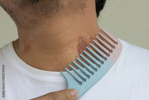 Photo of comb curing a hickey on a person's neck. photo