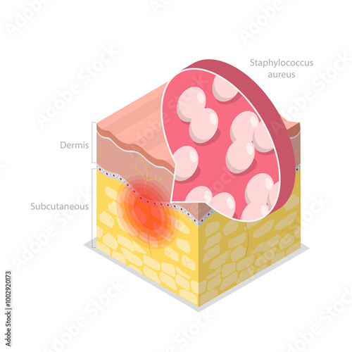 3D Isometric Flat  Illustration of Cellulitis, Bacterial Infection photo