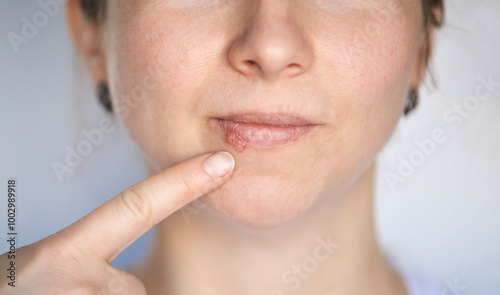 Skin care and lip health awareness with close up focus on cold sore and finger pointing for dermatology education