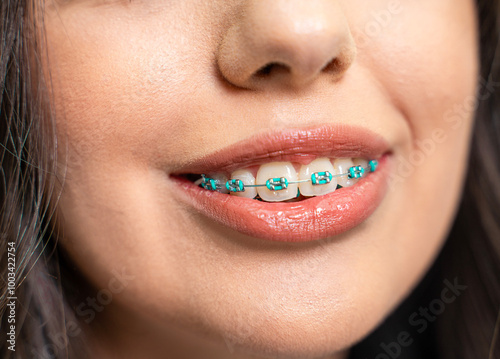 Closeup shot of just young woman month with dental brackets 