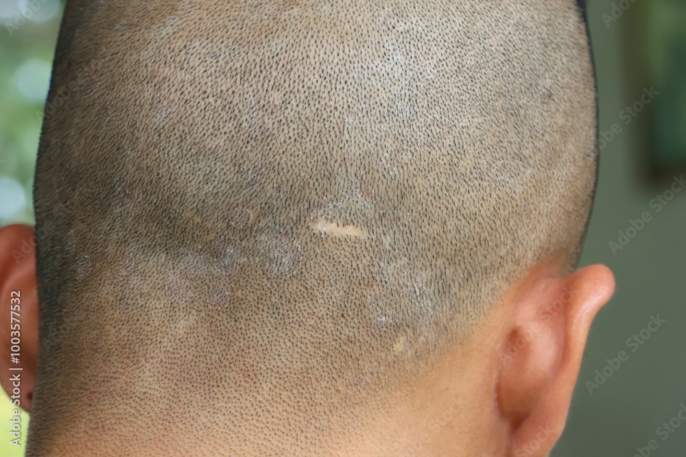 Naklejka premium Scars on the skin of the head