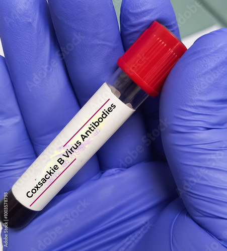 Blood sample for Hand foot and mouth disease (HFMD) test. It is a highly contagious infection. It's caused by viruses from the Enterovirus genus, most commonly the coxsackievirus. photo