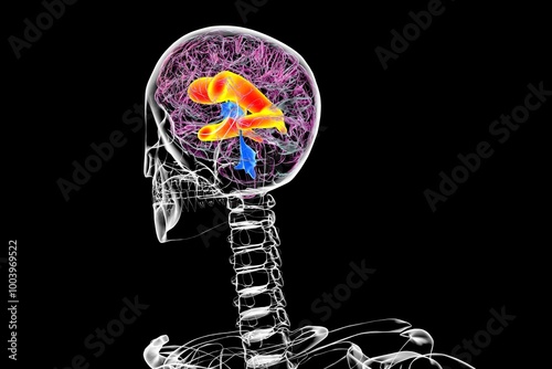 Enlarged lateral ventricles of the brain, 3D illustration photo