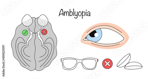 Amblyopia