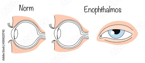 Enophthalmos