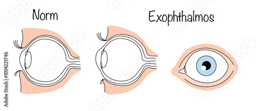 Exophthalmos
