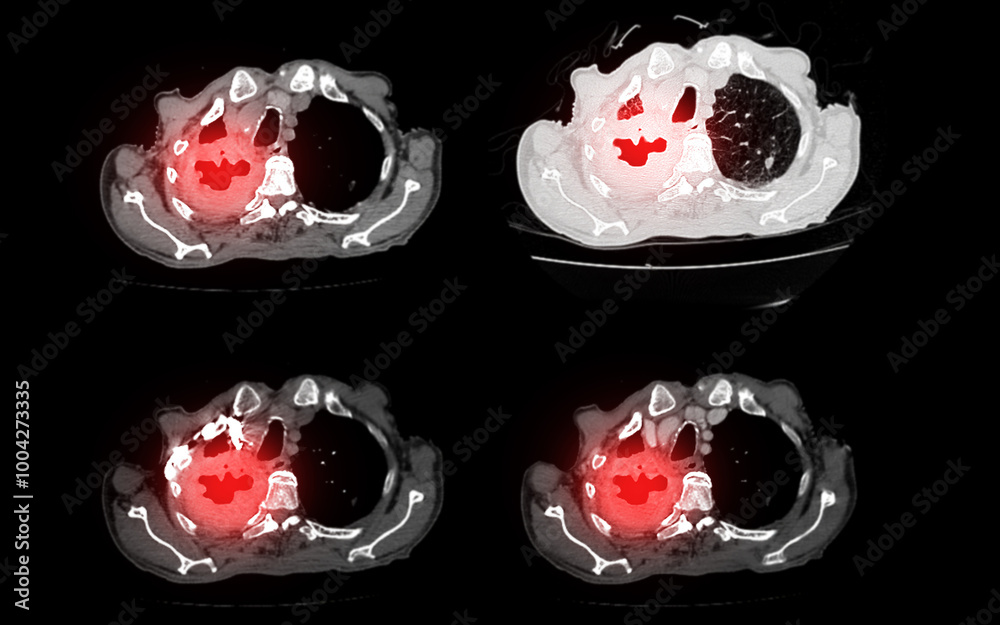 A CT scan of the chest showing multiple cross-sectional views ...