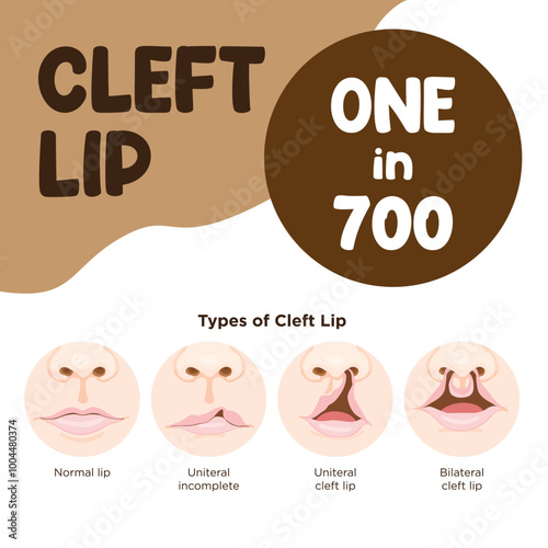 Vector illustration shows the difference between a normal lip, uniteral cleft lip and bilateral cleft palate