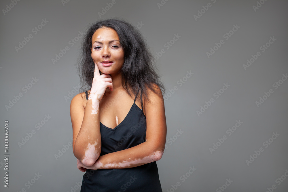 Confident female fashion model with hand on chin against gray background. Portrait of young lady with vitiligo skin disease standing at studio. Confident female fashion model with hand on chin against gray background. Portrait of young lady with vitiligo skin disease standing at studio.