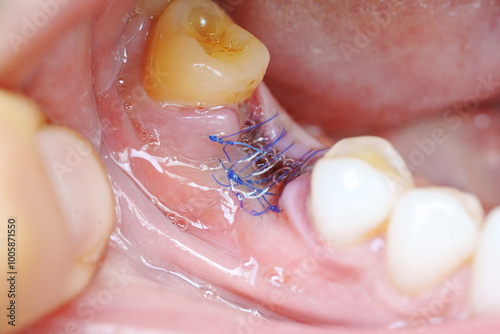 close-up. a sutured socket in the oral cavity after tooth extraction. the work of a dentist surgeon.