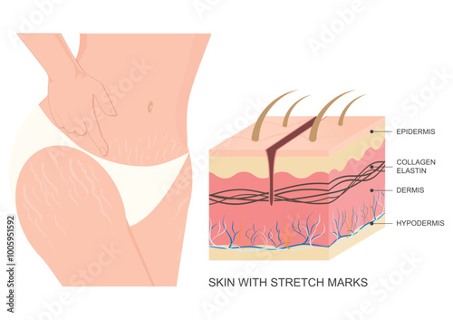 Skin with Stretch marks appear.