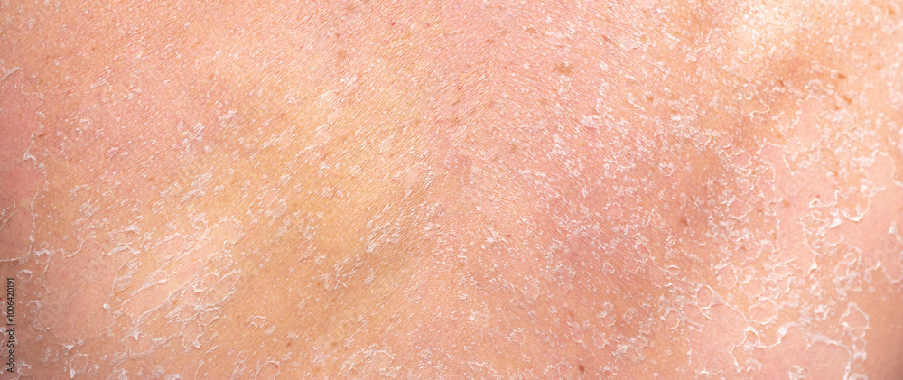 Sunburn, close-up of human skin. Flaky skin from allergies, peeling or eczema. Dry skin in need of treatment and hydration. Sunburn, close-up of human skin. Flaky skin from allergies, peeling or eczema. Dry skin in need of treatment and hydration.
