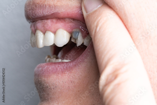 Caucasian male open mouth and teeth with broken upper premolar tooth after dental root canal treatment. Dark gray dental cement before permanent new crown. Close up macro shot photo