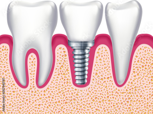 Implant among healthy teeth. Dental treatment. Stomatology prosthesis