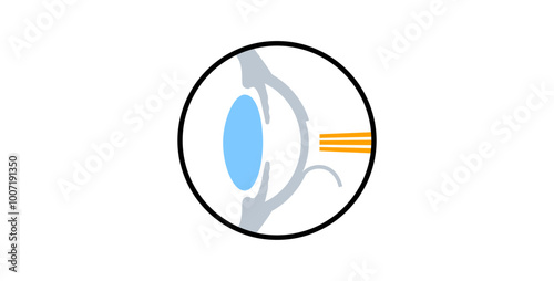 Lasik eye surgery