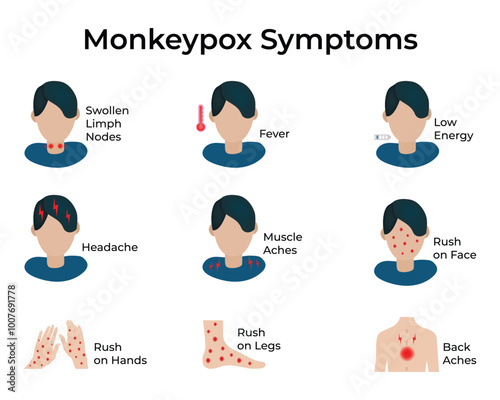 Monkypox Symptoms Science Vector Illustration
