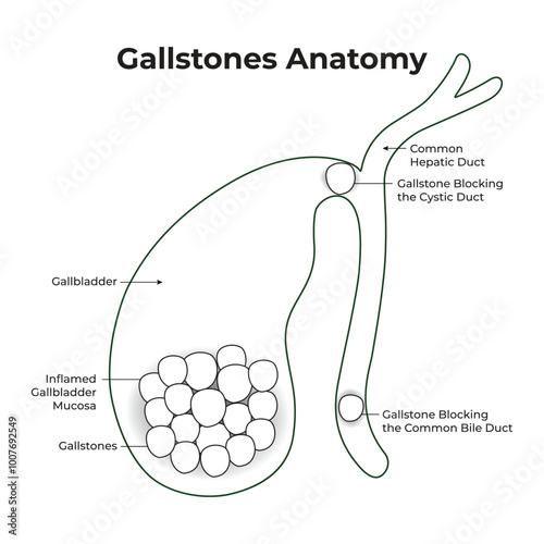 Gallstones Anatomy Gallbladder Hepatic Duct Mucosa Science Vector Illustration