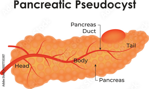 Pancreatic Pseudocyst Head Body Pancreas Pancreas Duct Science Vector Illustration