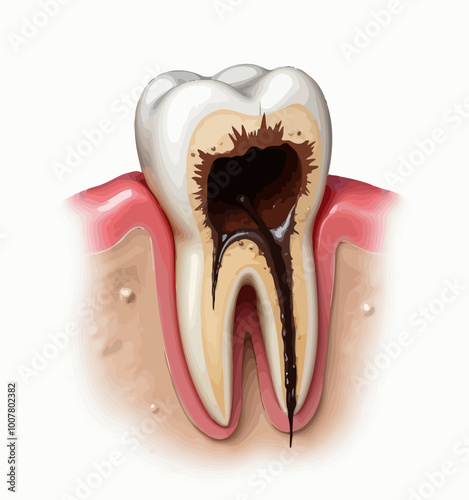 Tooth nerve infection and root canal treatment illustration