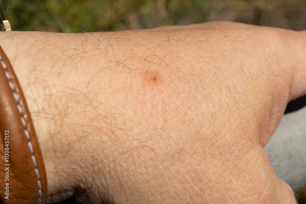 Fototapeta premium Female Common horse fly or Cleg fly (Haematopota pluvialis) bite wound on human hand skin close-up
