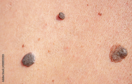 Nevus close-up. Mole on human skin. Irregular birthmark.