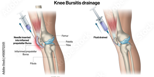 Knee Bursitis Drainage Medical Treatment, Joint Inflammation Therapy, Orthopedic Procedure