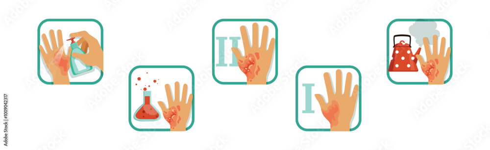 Hand Burn Degree and First Aid Procedure Vector Set Hand Burn Degree and First Aid Procedure Vector Set