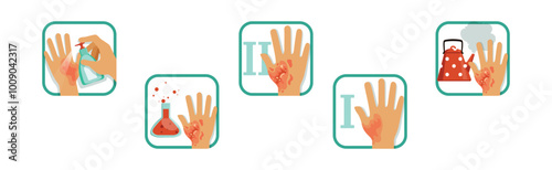 Hand Burn Degree and First Aid Procedure Vector Set