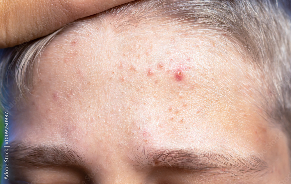 Teenage acne on a boy's forehead close-up