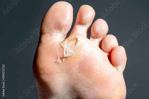 Foto A close-up of a foot with calluses showing the healing process of a blister on t