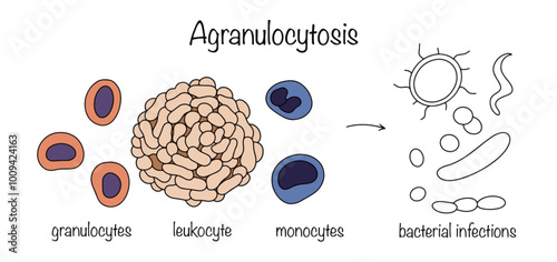 Agranulocytosis
