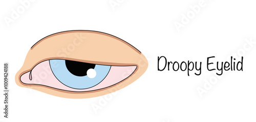 Droopy Eyelid