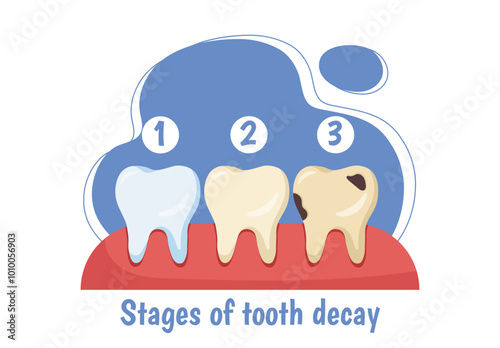 Stages of tooth decay. Medical infographics and educational materials. Cleanliness and hygiene. Diagnosis and treatment. Flat vector illustration isolated on white background