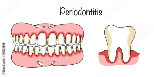 Periodontitis