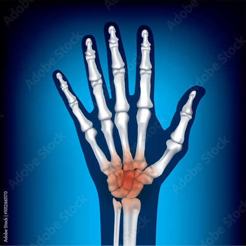 Five finger bones of a man on a blue background.Bones of a human hand on a blue background. Inflammation of the joints. Medical poster. Vector illustration