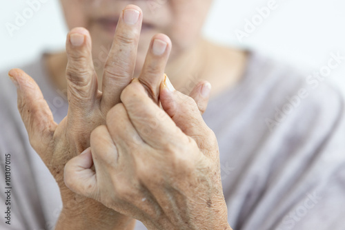 Close up of hands,senior woman suffering from Rheumatoid Arthritis,autoimmune disease,old elderly has pain in her fingers,painful inflammation and stiffness of the joints,chronic progressive disease photo