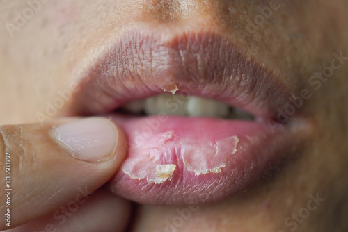Close up photo of A man suffering from chapped lips. Concept for skincare and oral disease.