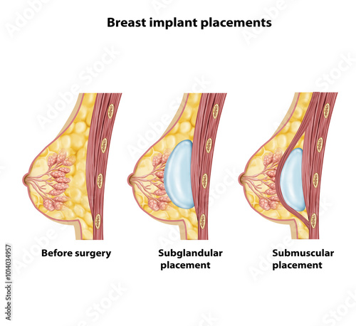 breast implant placements structure diagram 