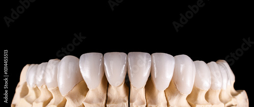 ceramic emax veneers photo