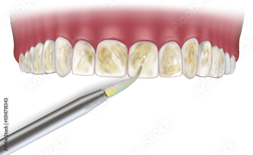 Laser Removal of Dental Calculus. Dental laser. Laser Gum Therapy 